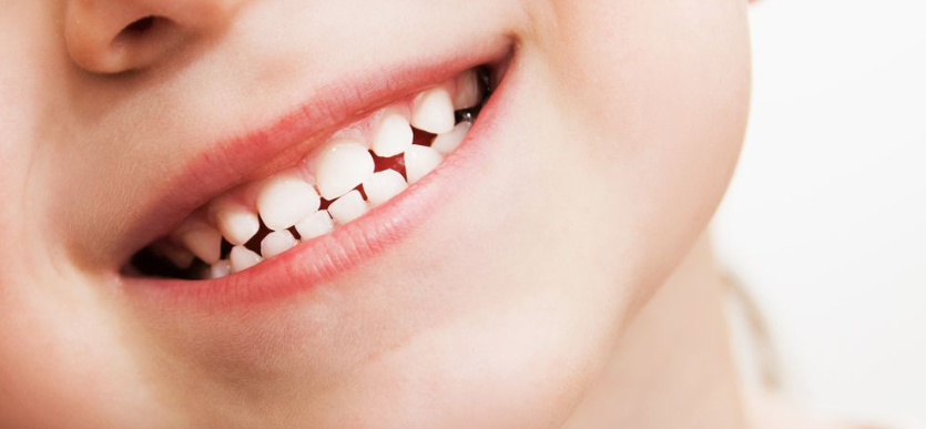 5 Cara Cepat Membuat Gigi Putih yang ampuh